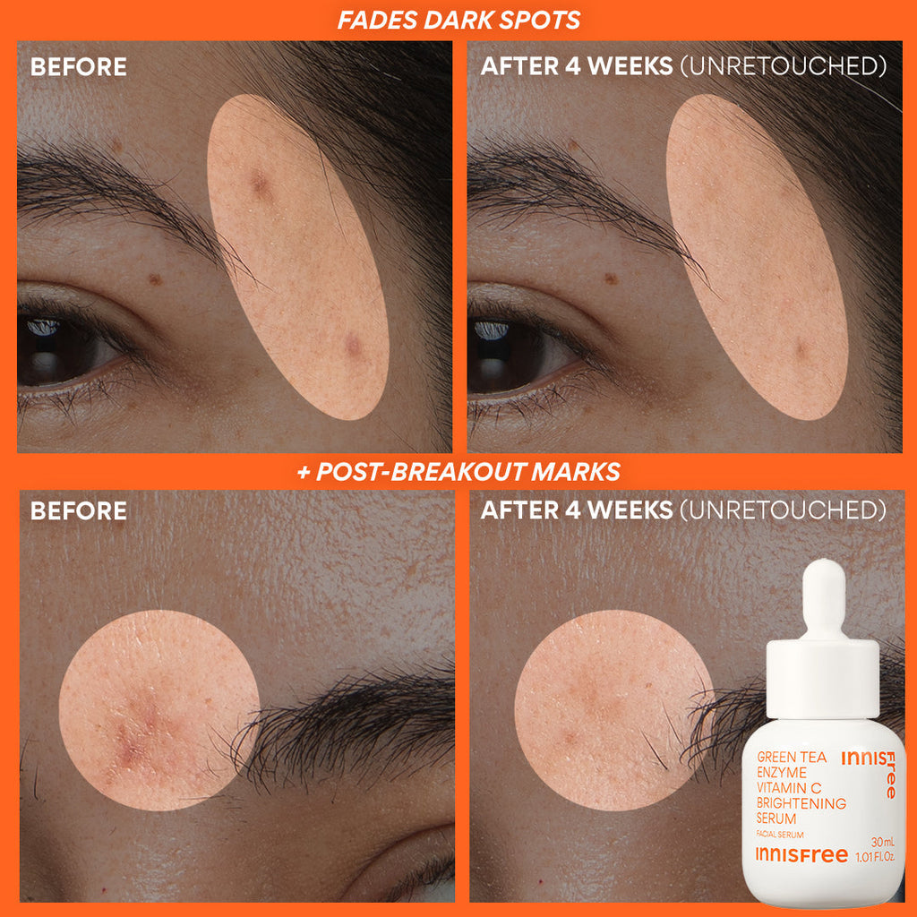 fades dark spots and post-breakout marks before and after vitamin c serum