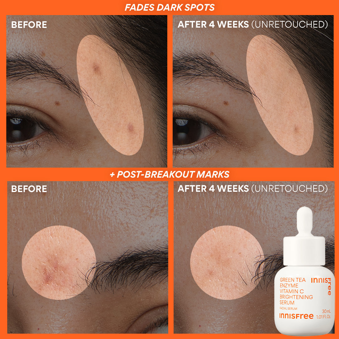 fades dark spots and post-breakout marks before and after vitamin c serum