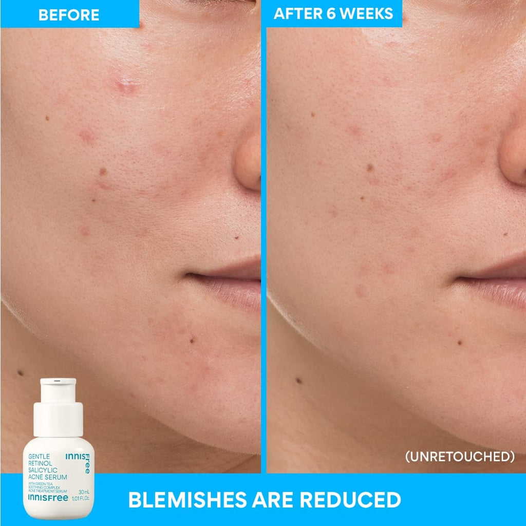 Gentle Retinol Salicylic Acne Serum before and after