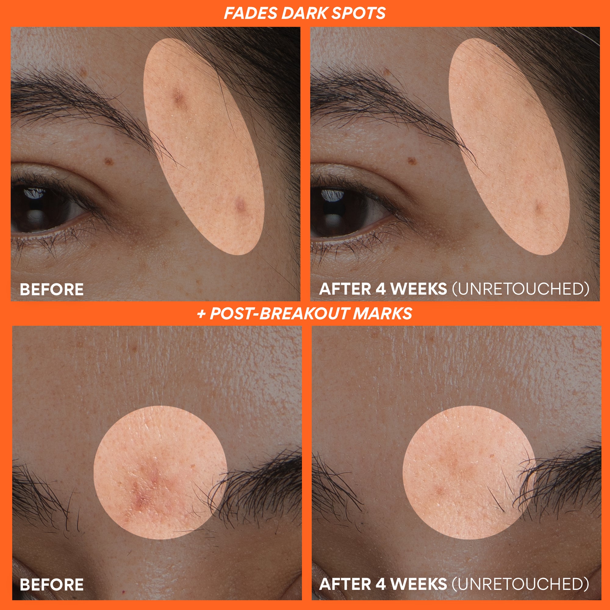 Before and after comparison of dark spots on skin