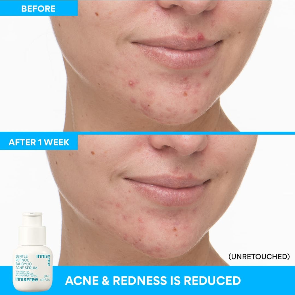 Gentle Retinol Salicylic Acne Serum before and after