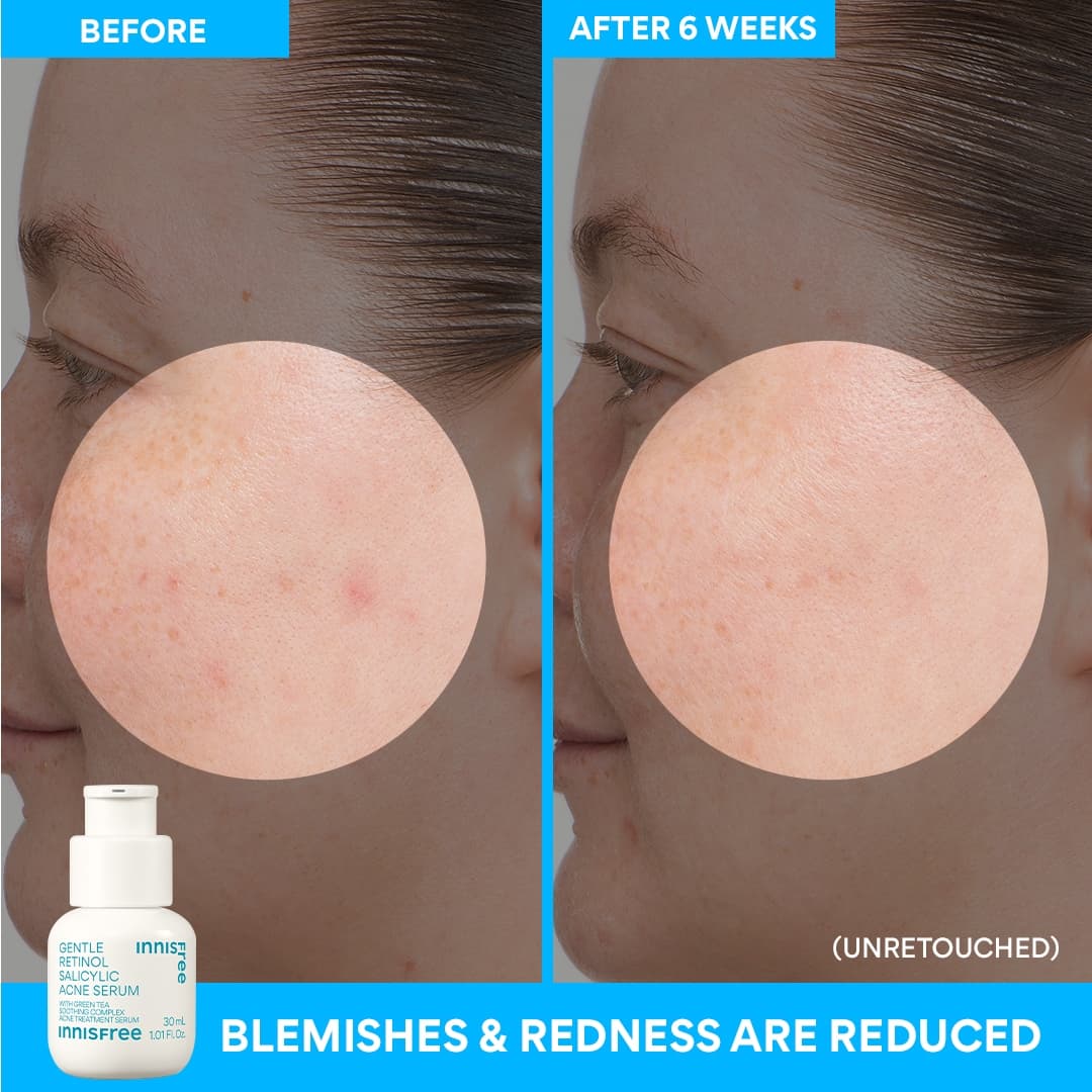 Gentle Retinol Salicylic Acne Serum before and after