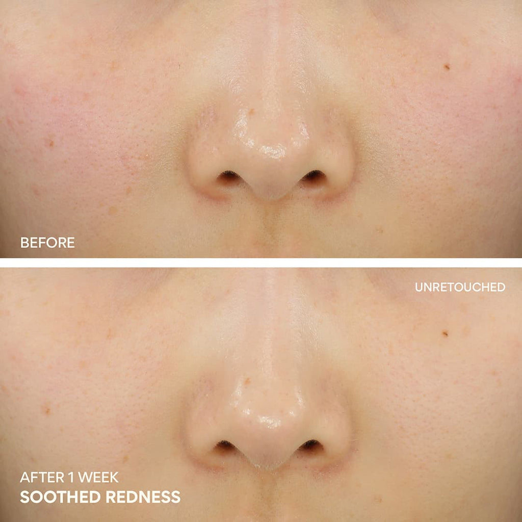 Green Tea Ceramide Cream soothes redness after using it for 1 week