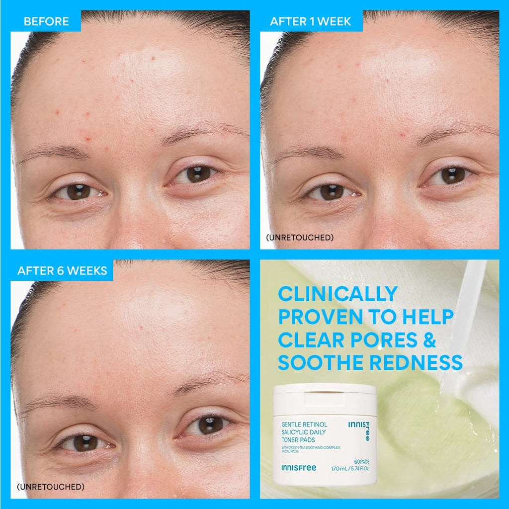 daily gentle retinol toner pads: clinically proven to help clear pores and soothe redness before and after 1 week and after 6 weeks