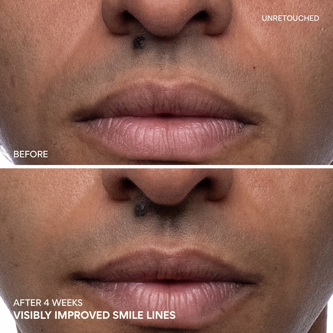 Green Tea PDRN™ Bounce Booster Eye & Lip Serum nasolabial folds before and after