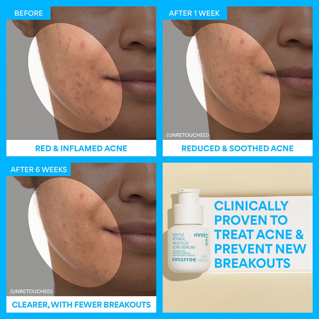 gentle retinol acne serum: clinically proven to treat acne and prevent new breakouts before and after 1 week and after 6 weeks