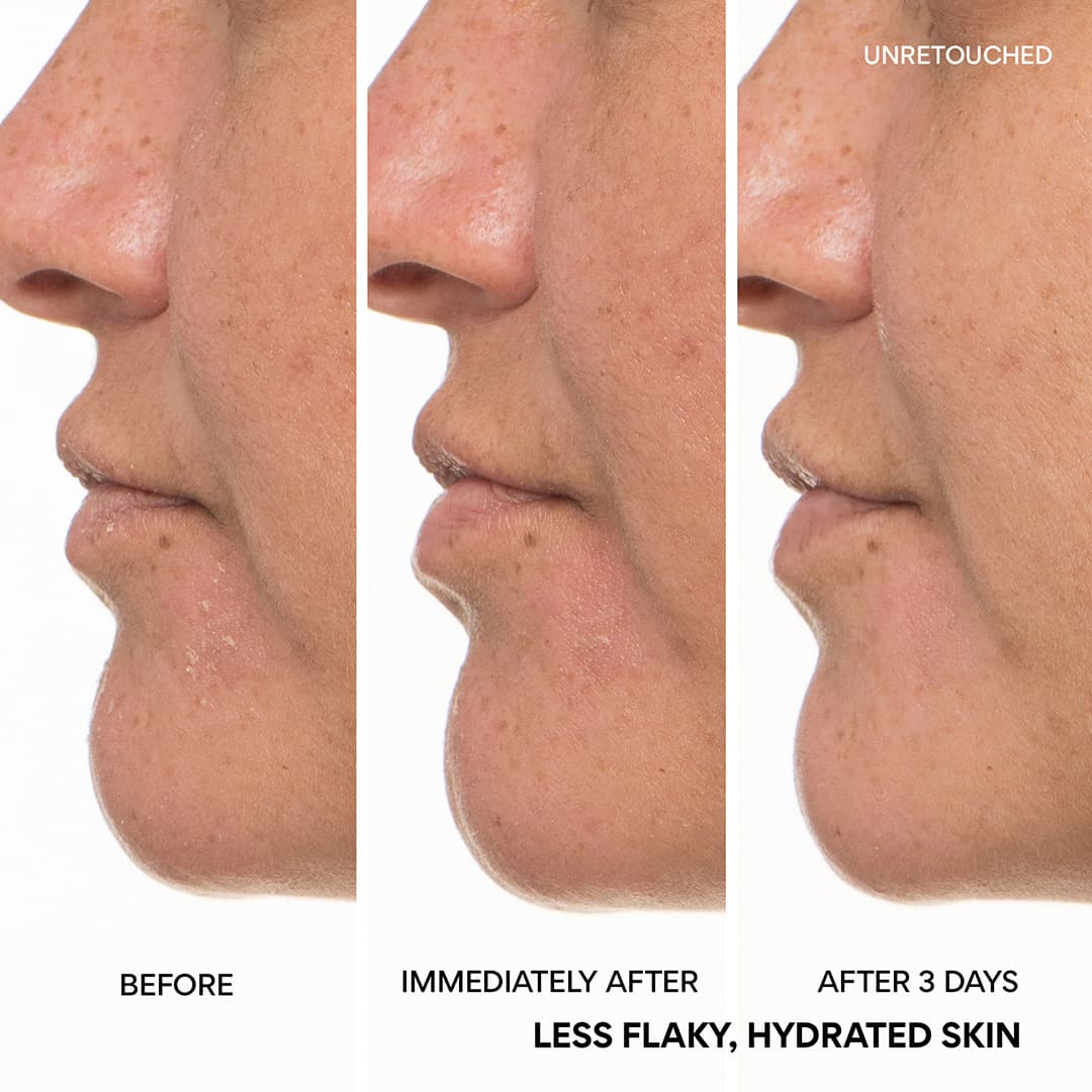 Skin looks less flaky and more hydrated after 3 days of using Green Tea Ceramide Milk Barrier Essence