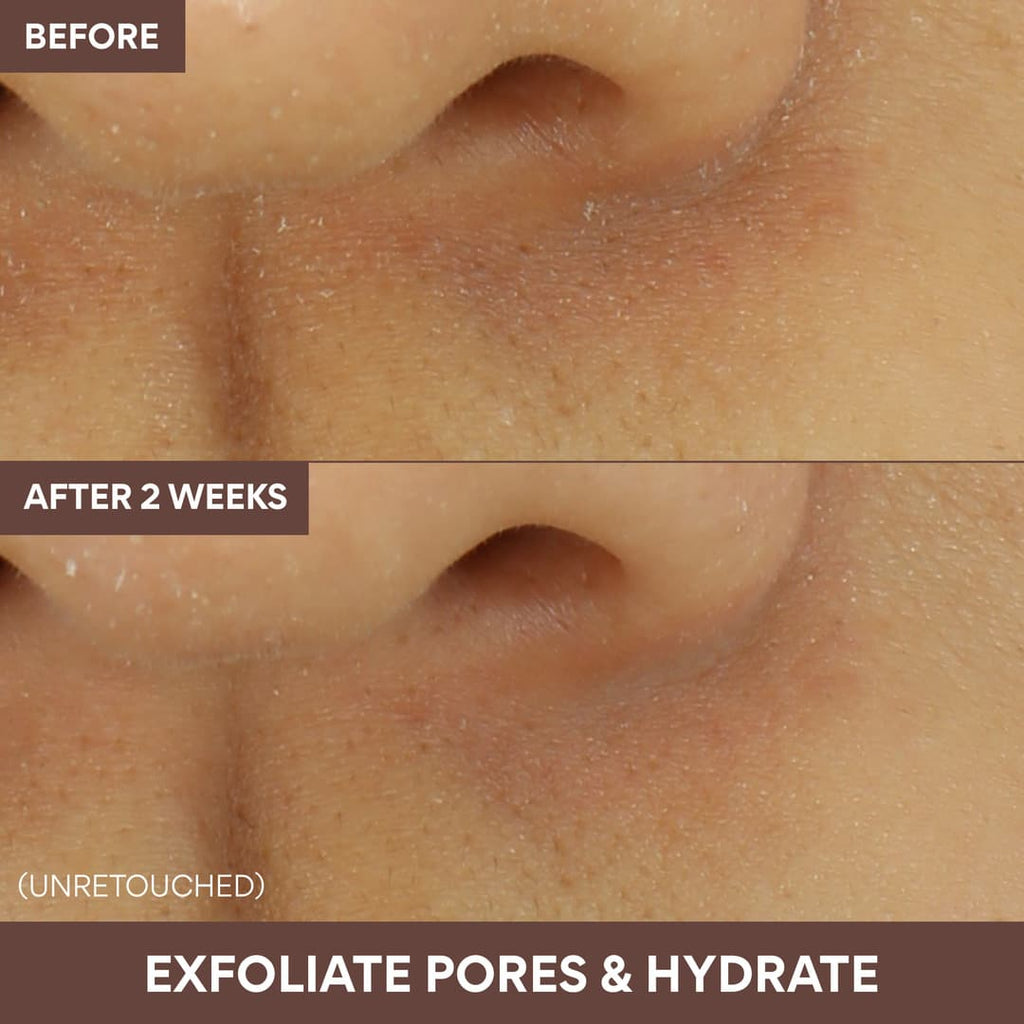 exfoliate pores and hydrate: before and after 2 weeks of using Volcanic Swirl Pore Mask