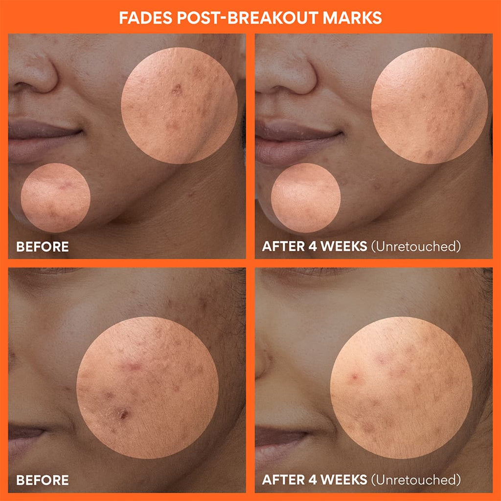 Green Tea Enzyme Vitamin C Brightening Toner Pads before and after