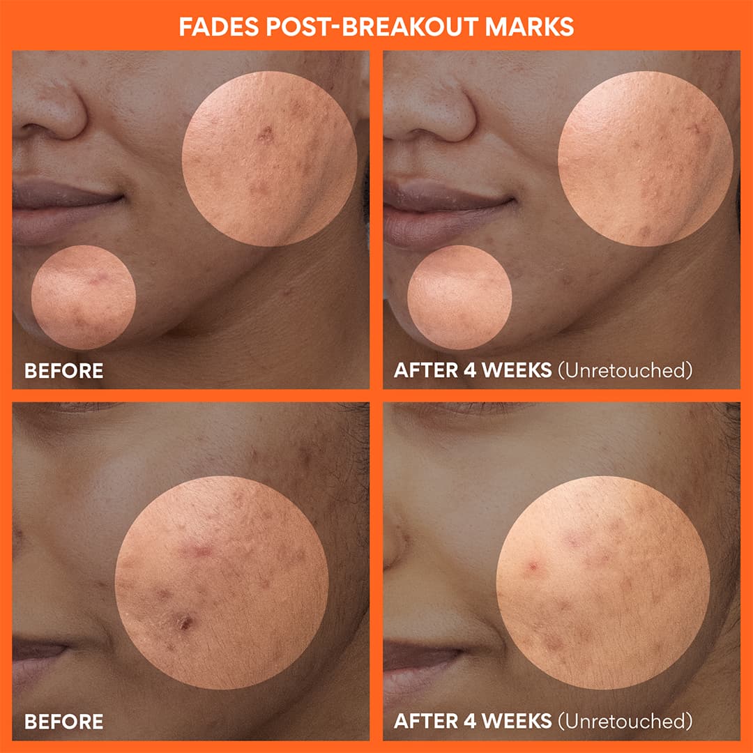 Green Tea Enzyme Vitamin C Brightening Toner Pads before and after