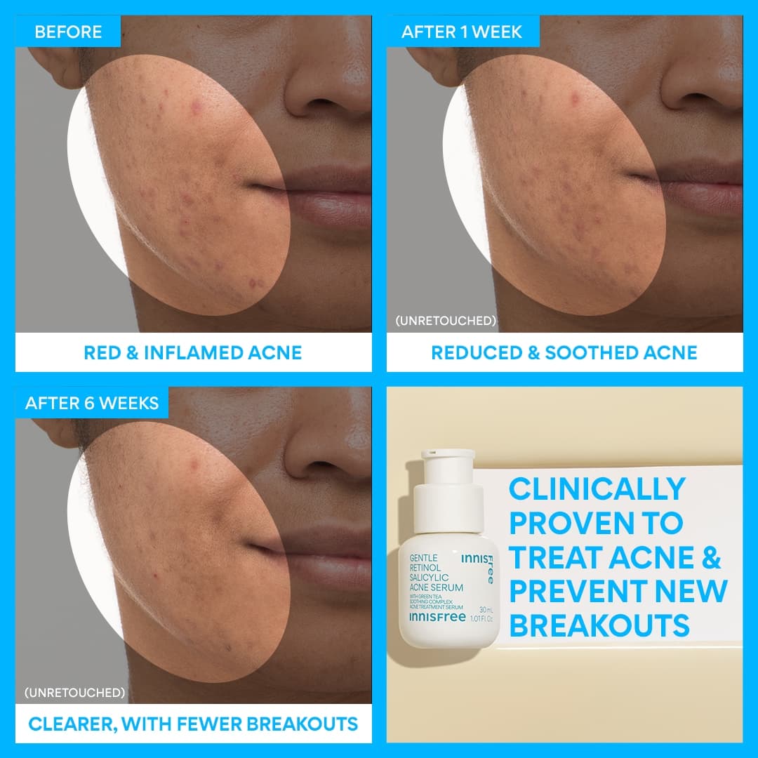 Gentle Retinol Salicylic Acne Serum before and after