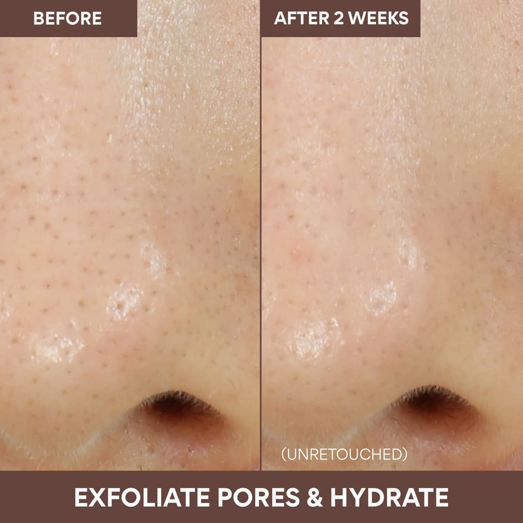 exfoliate pores and hydrate: before and after 2 weeks of using Volcanic Swirl Pore Mask